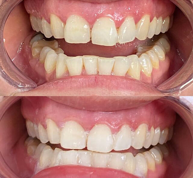 Tanden bleken voor en na